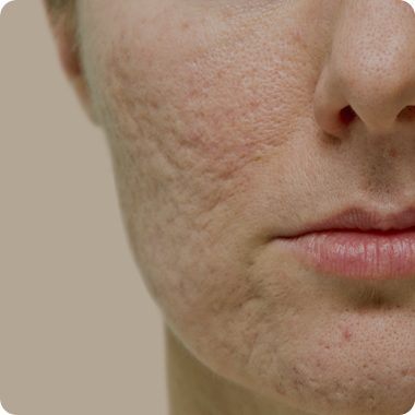 흉터/모공 치료